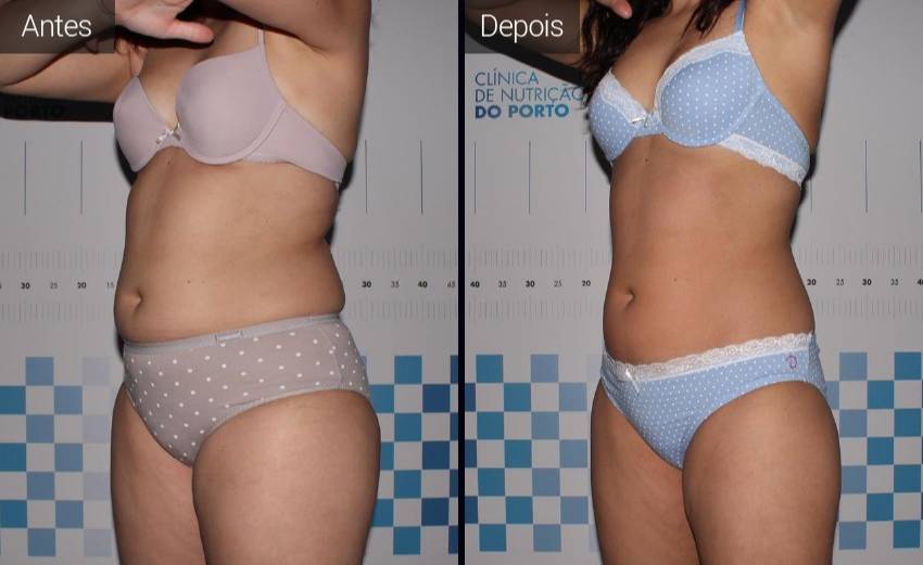 resultados - abdomen - flancos - coxa - vista lateral